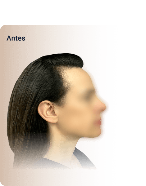 Clínica HA -Transplante Feminino